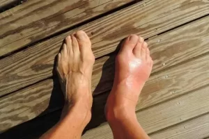 Pantangan Bagi Penderita Asam Urat: Jangan Sembarang Minum!