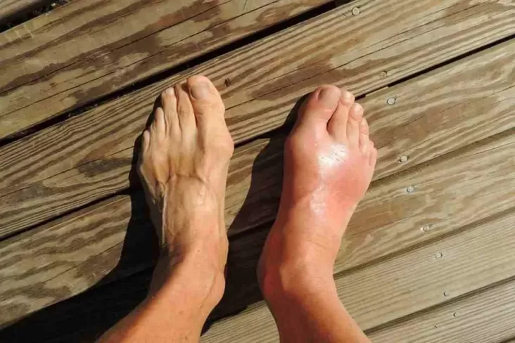 "Jangan Sembarangan Minum! Ini Pantangan bagi Penderita Asam Urat"